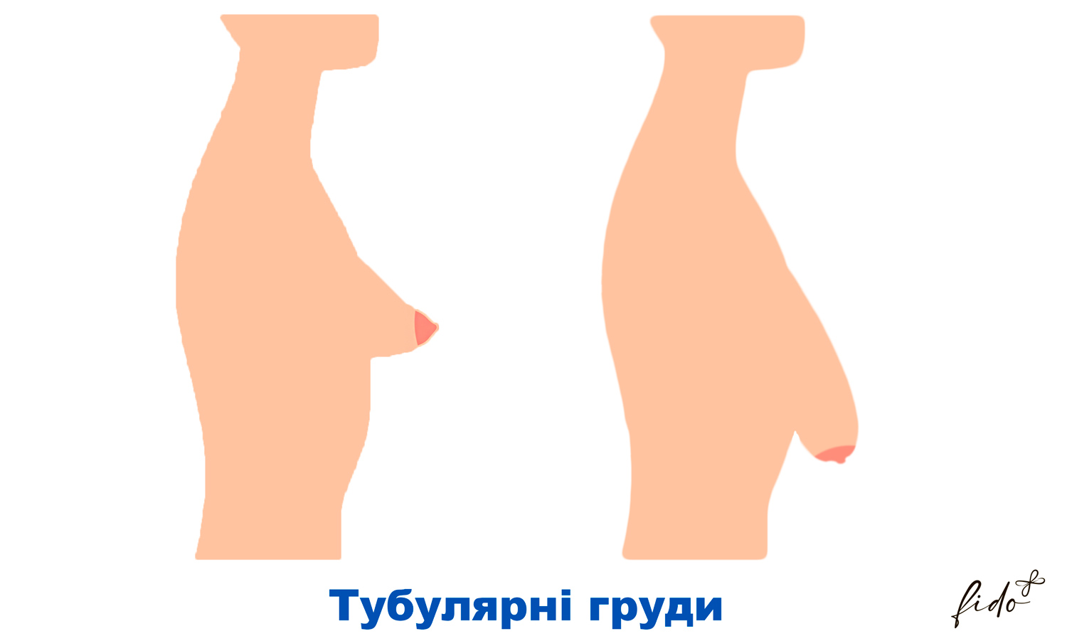 тубулярная грудь